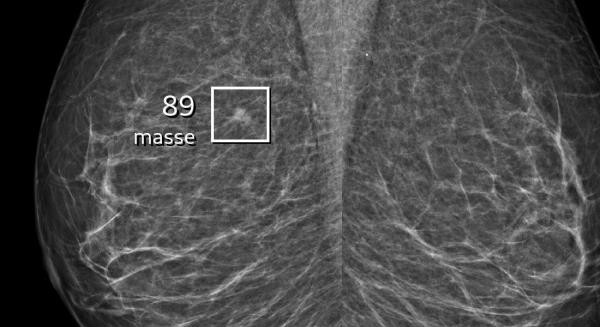 screening of breastcancer