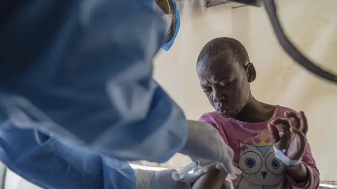 A doctor checking a boy with mpox